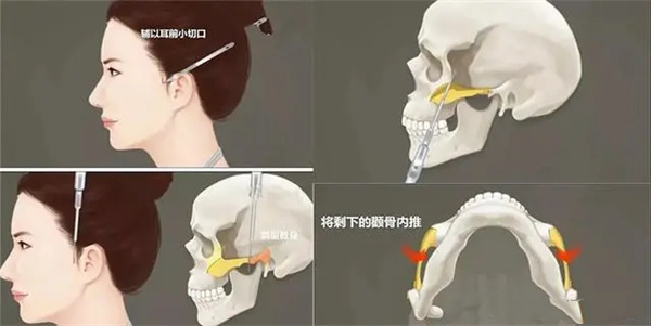 黄大勇做颧骨跟下颌角费用多少