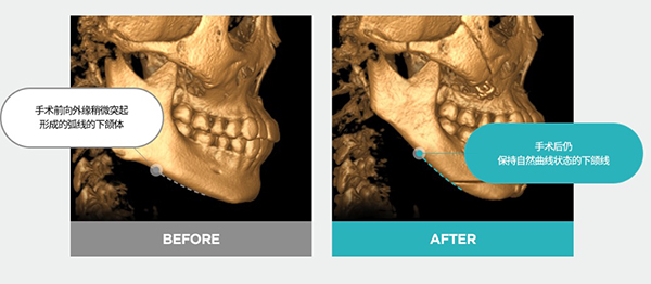 下颌角二次角是什么意思？看韩国TS整形外科李相均如何避免二次角