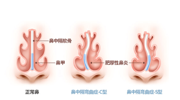 鼻中隔弯曲矫正术