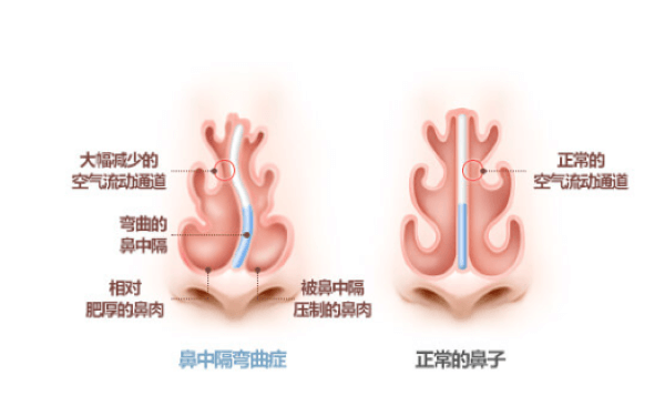 鼻中隔弯曲症