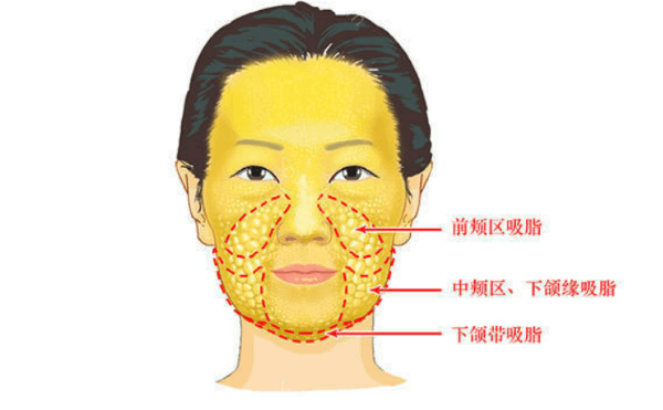 面部激光溶脂