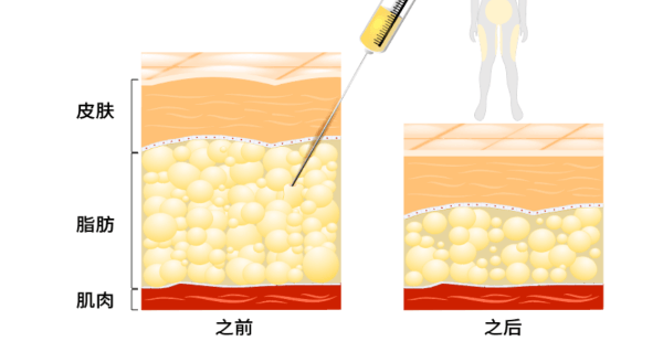 面部减脂