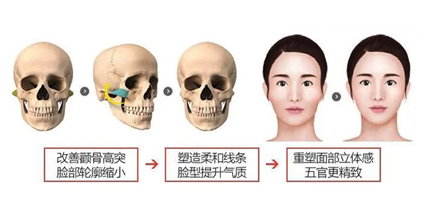 颧骨内推后骨头还能长到一起吗