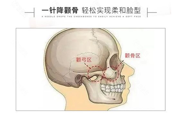 广州一针降颧骨的医院是哪家？广州曙光医学美容医院做的不错