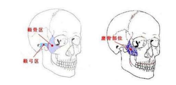 广州一针降颧骨的医院是哪家？广州曙光医学美容医院做的不错