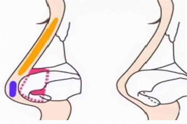 广州隆鼻手术对比图