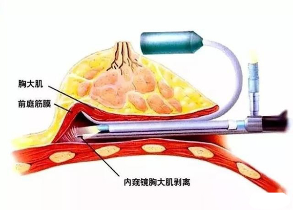 葛海辉医生隆胸优点介绍