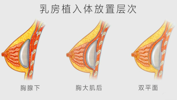 假体隆胸