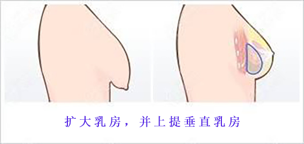 重庆安可忍医生做丰胸怎么样