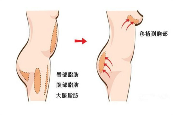 北京圣嘉新大脂肪萃取