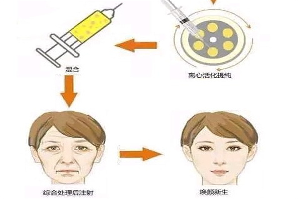 北京圣嘉新医疗美容医院脂肪萃取技术