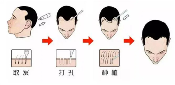 植发医院收费价目表大全