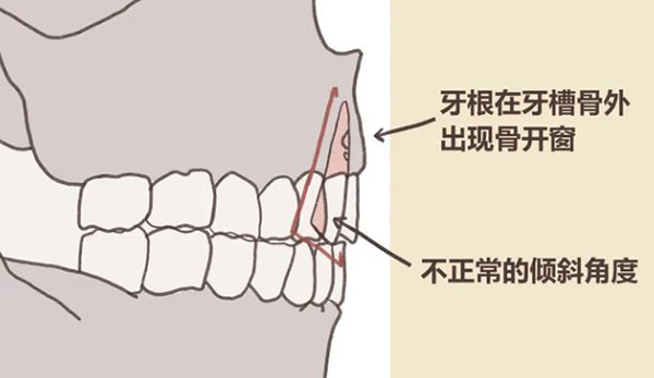 骨开窗