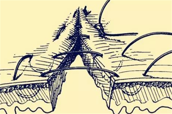 什么是皮下缝合