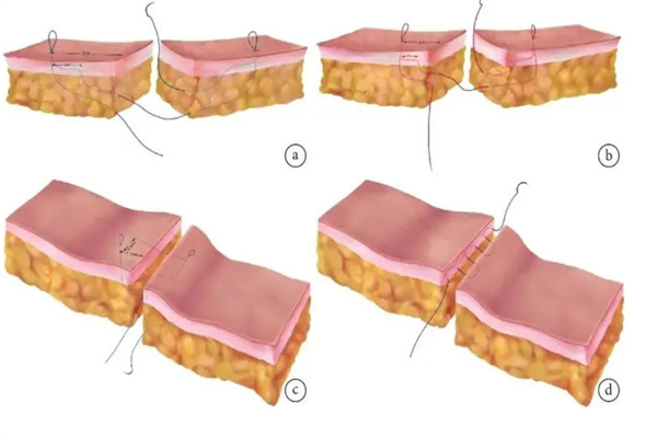 皮内缝合皮下缝合不留疤