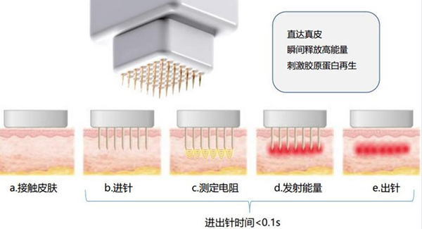 治疗痘坑痘印哪个仪器成效好