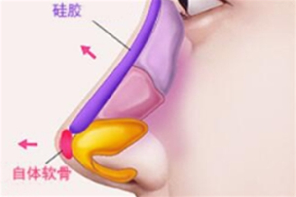 做猪鼻子动作原理