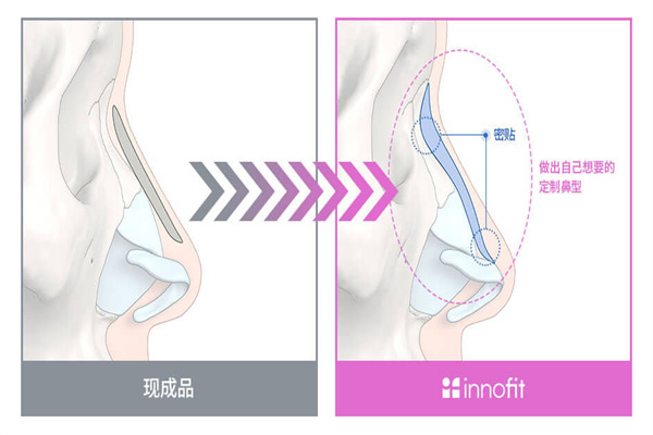 GNG医院3D打印假体