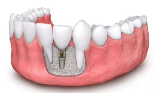 种植牙