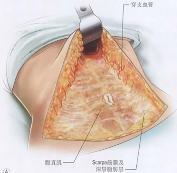 腹壁成形术是什么手术