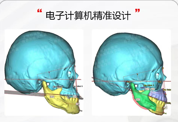 反颌矫正术哪个医院做得好