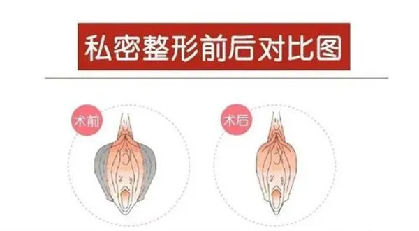 3d生物束带紧缩术后真的有效吗