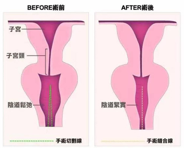 3d生物束带紧缩术后真的有效吗