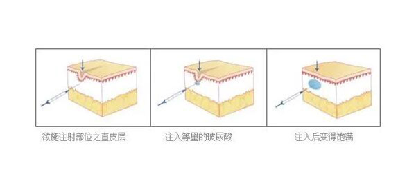 苹果肌凹陷怎么修复饱满