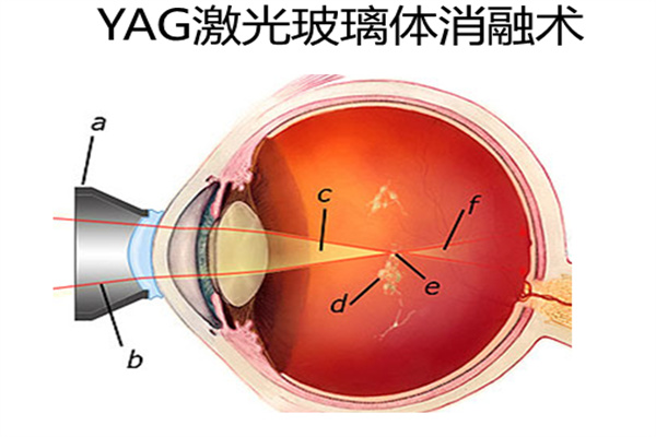 什么是玻璃体切除术