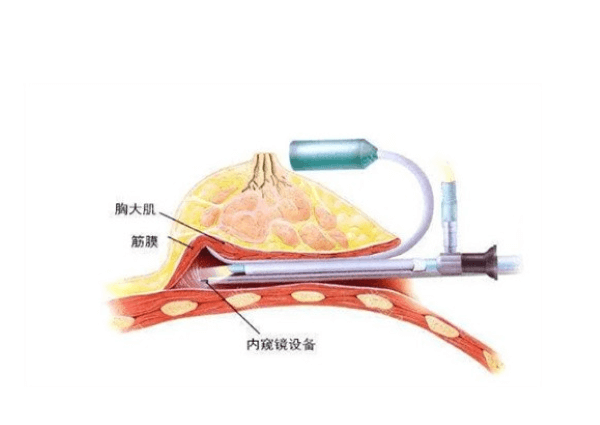 内窥镜丰胸