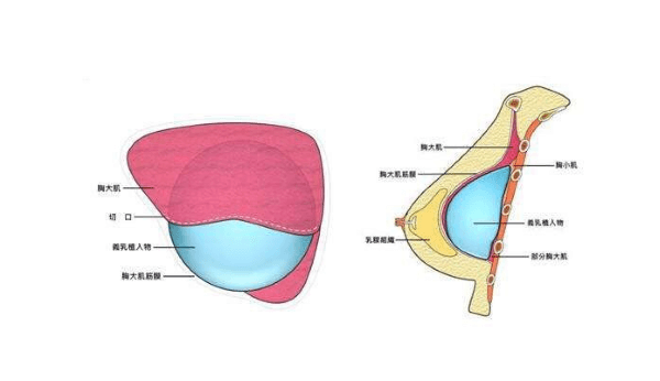 内窥镜隆胸