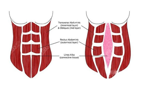 腹壁成型手术怎么做