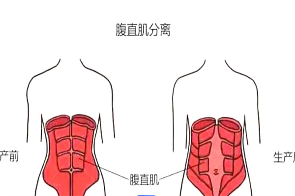 腹壁成型手术疗效