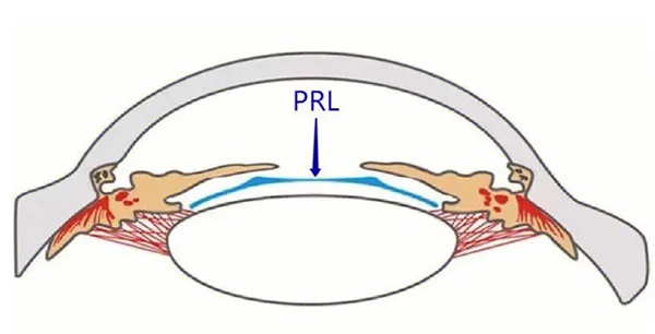 prl晶体植入术