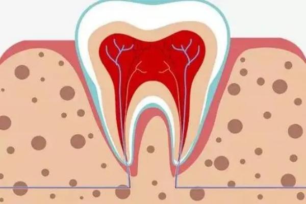 牙髓炎切面图