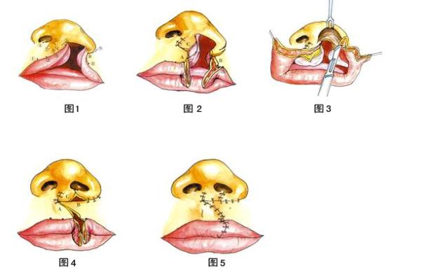 唇腭裂图片介绍