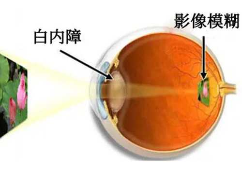 糖尿病引起的白内障