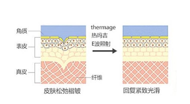 做热玛吉多久可以化妆?热玛吉什么时候才能修复?