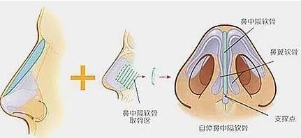 李文信医生做鼻子怎么样？隆鼻风格怎么样？隆鼻手术实例