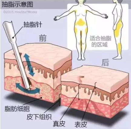 抽脂前有哪些注意事项?什么是过于肥胖?