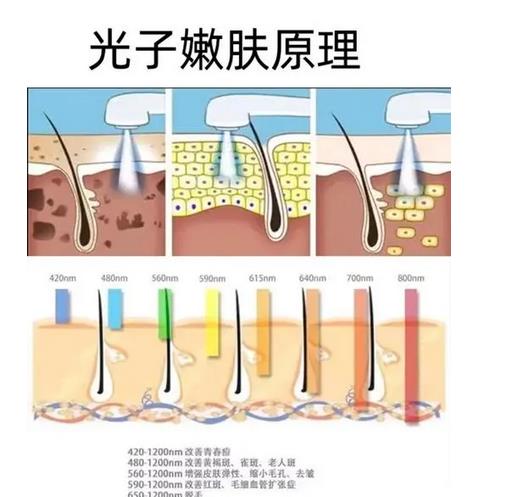 光子嫩肤是否会反弹