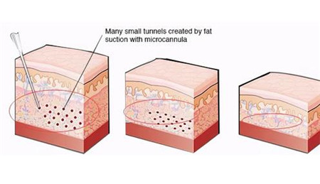 水动力吸脂和普通吸脂有什么不同之处