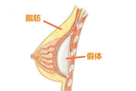 一般在隆胸术后有哪些注意事项