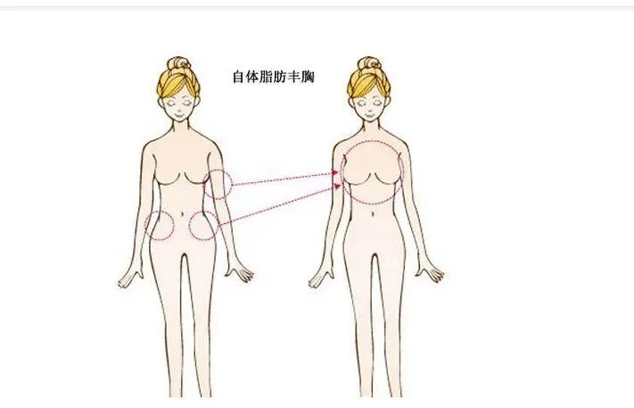 自体脂肪丰胸之后较好的护理方法是什么?