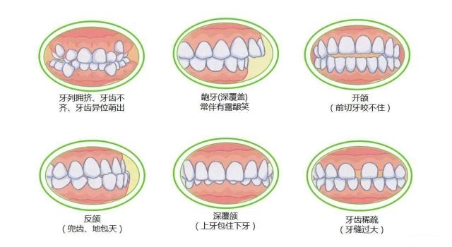 龅牙如何矫正，有哪些方法？