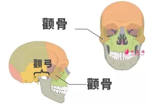 颧弓缩窄手术适合与不适合哪些人？