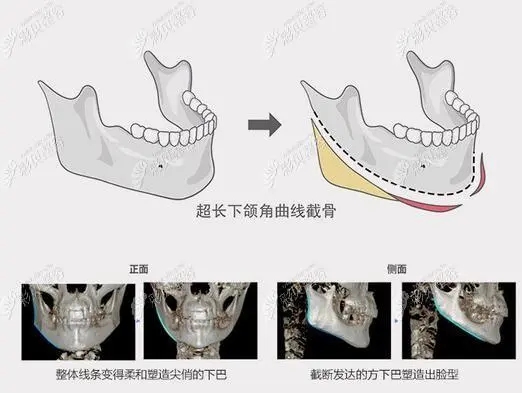 磨下颌角的优势是什么？磨下颌角的外科手术过程