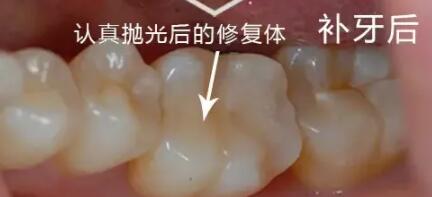 牙齿烂了一个洞很痛怎么办？有什么良好的解决方法吗？赶紧进来学习！