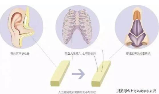 哪些因素影响自体软骨垫鼻基底的费用?自体软骨垫鼻基底有什么优势呢?