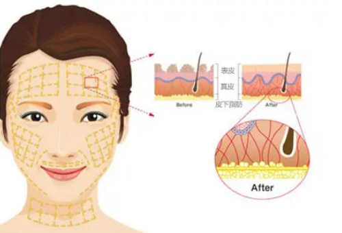 胶原蛋白除皱是怎么回事？术后形态很真实